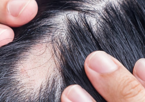 Alopecia: Understanding Hair Loss and Finding Solutions